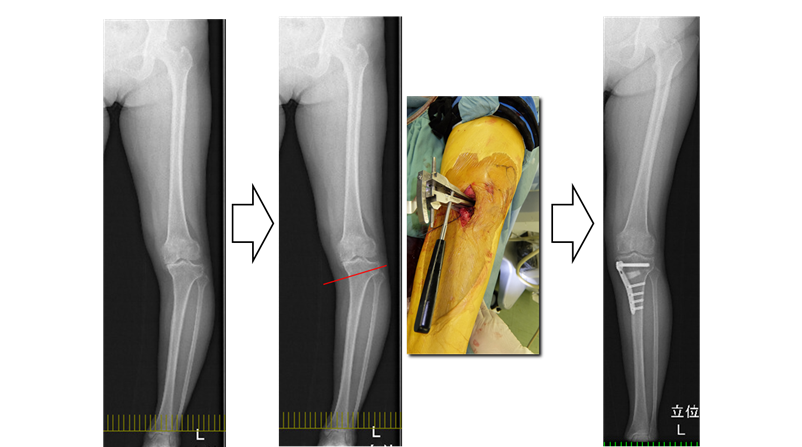 膝関節外科学 南江堂 変形性膝関節症診療ガイドライン2023: 書籍／南江堂